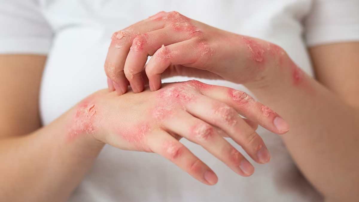 How can I treat fungal skin infection?